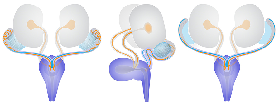 3D schematic views of sex-specific paramesonephric and nephric duct dengeneration